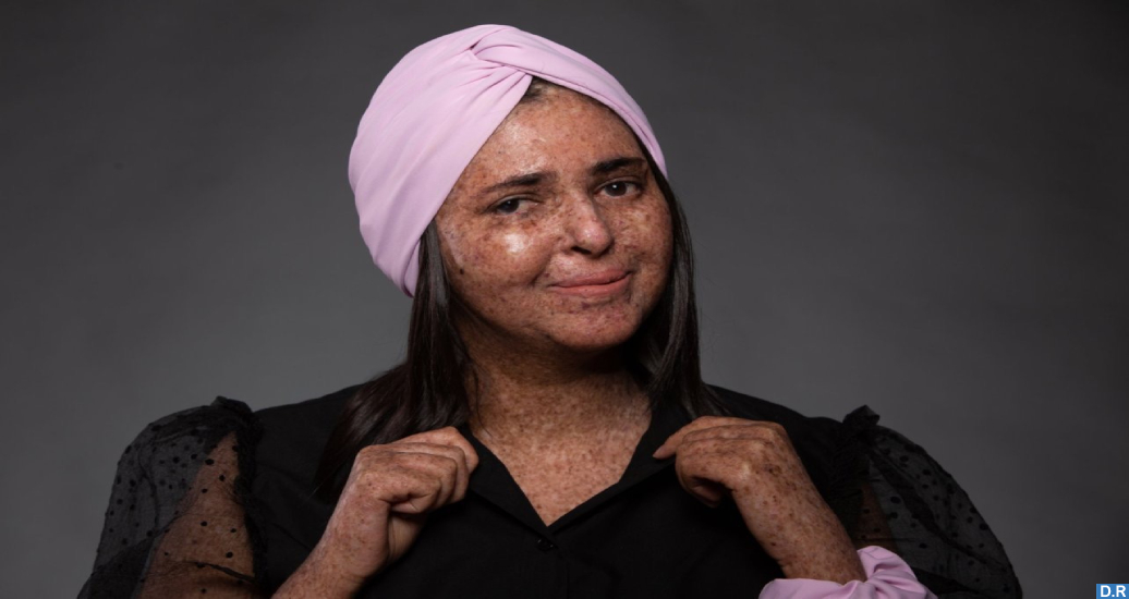 Fatima Zahra Ghazzaoui : un combat soutenu pour la sensibilisation aux souffrances des enfants de la lune